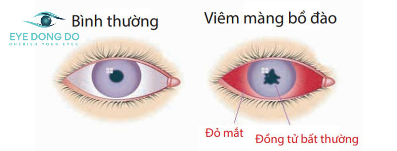 Viêm màng bồ đào là một bệnh lý thường gặp ở mắt có tỉ lệ mắc rất cao