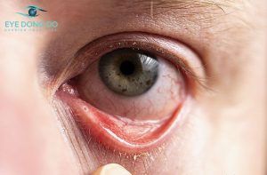 Tỷ lệ người mắc bệnh viêm giác mạc sợi thường rất cao