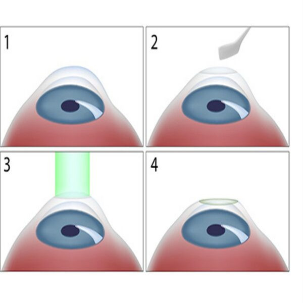 Giá phương pháp Smartsurface khác giá mổ mắt lasik 