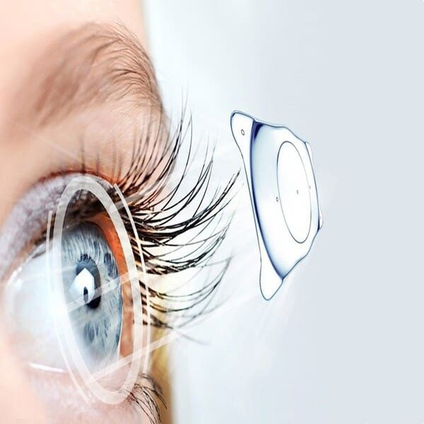 Chênh lệch mổ mắt lasik giá với Phương pháp Phakic ICL
