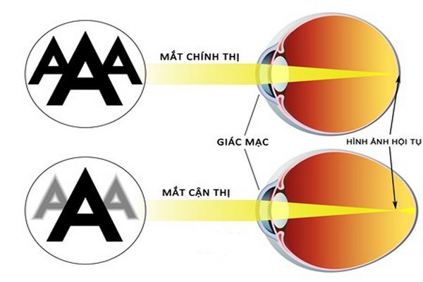 4. Phương Pháp Chẩn Đoán Cận Thị Nhẹ