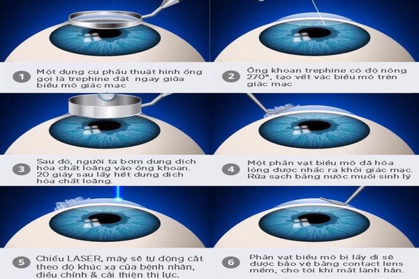 Phẫu thuật Lasik là phương pháp tối ưu được lựa chọn để điều trị cận thị