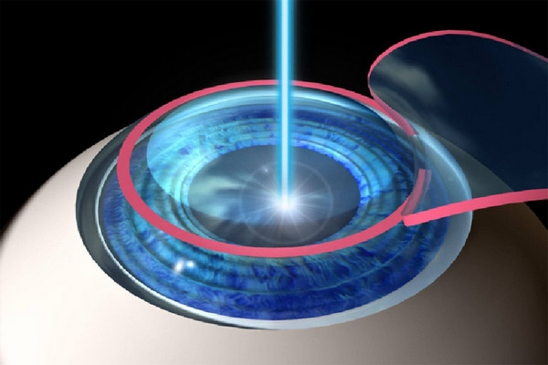 Phẫu thuật Lasik, điều trị cận thị có thời gian phục hồi rất nhanh