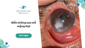 Những biến chứng sau mổ mộng thịt và cách chăm sóc mắt sau mổ