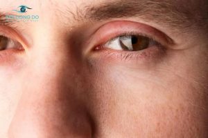 Những cách hết sưng mí mắt đơn giản, hiệu quả nhất