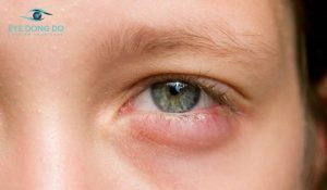 Mí mắt bị sưng dưới là tình trạng phổ biến 