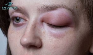 Người bệnh bị sưng mí mắt do các tác nhân dị ứng