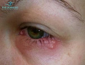 Bệnh nấm mắt gây ảnh hưởng tới thị lực của bệnh nhân