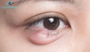 Hình minh họa bệnh nhân bị mụt lẹo ở mắt (mụt lẹo)
