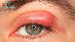 Khối u ở mí mắt gây ra tình trạng sưng đỏ mí mắt