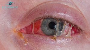 Khi ghèn mắt xuất hiện nhiều là dấu hiệu cảnh báo bệnh lý về mắt