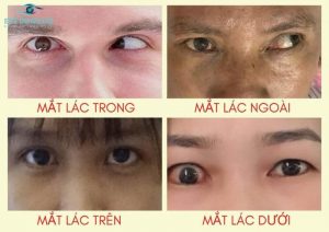Mắt lác có thể gặp ở nhiều lứa tuổi