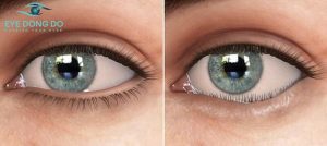 Quặm mi là hiện tượng lông mi mọc ngược gây khó chịu sinh hoạt