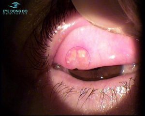 Sạn vôi ở mắt xuất hiện ở vị trí dưới kết mạc mi