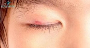 Nguyên nhân gây bệnh ung thư mi mắt vẫn chưa được xác định rõ