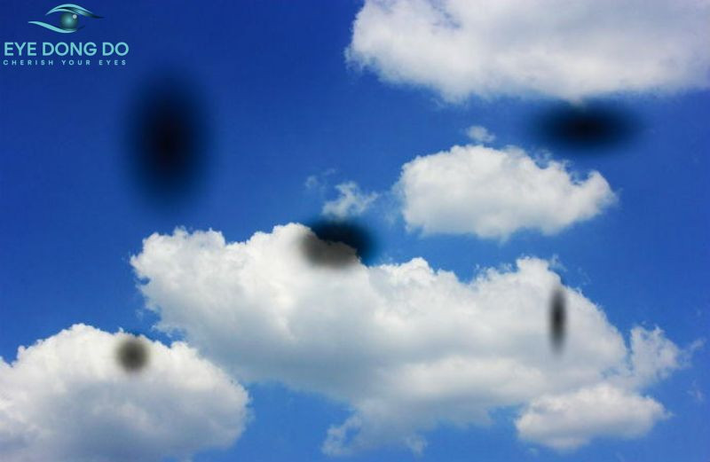 Người bệnh xuất hiện các đốm đen trong tầm nhìn