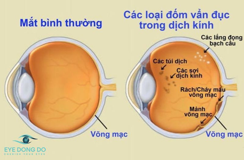 Vẩn đục dịch kính là tình trạng nhiều người gặp phải