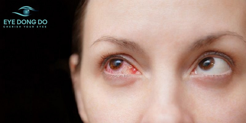 Các cách chữa đau mắt đỏ tại nhà nhanh chóng, hiệu quả