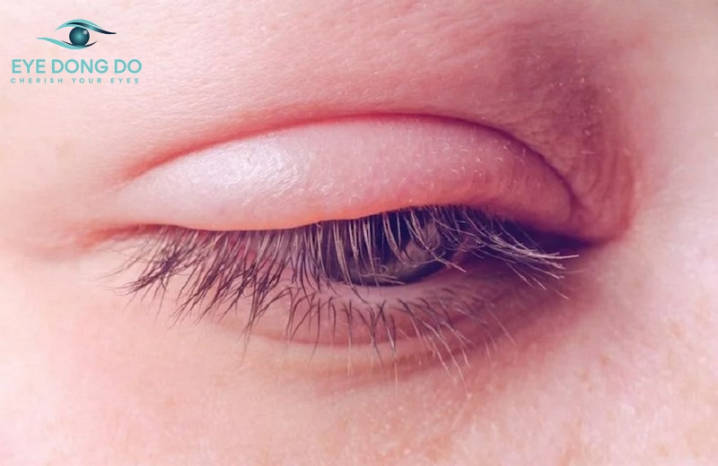 Sưng mắt kéo dài có thể là dấu hiệu bệnh lý về mắt