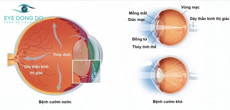 Cườm mắt là tên gọi tổng quát về mắt phổ biến là cườm khô và cườm nước