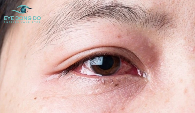 Bị đau mắt đỏ bao lâu thì khỏi? Cách điều trị và phòng ngừa