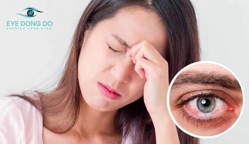 Đau mắt đỏ có lây không? Cách chữa bệnh đau mắt đỏ hiệu quả